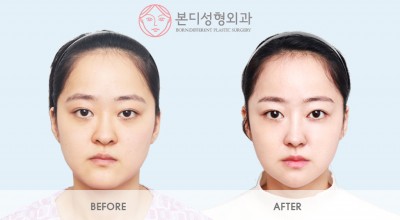 사각턱, 광대, 작은얼굴주사