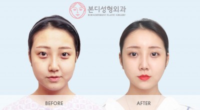 노핀광대축소술, 옆광대고정, 45도광대축소, 이중턱지방흡입