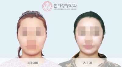 노핀광대축소술, 옆광대고정, 45도광대축소, 이중턱지방흡입