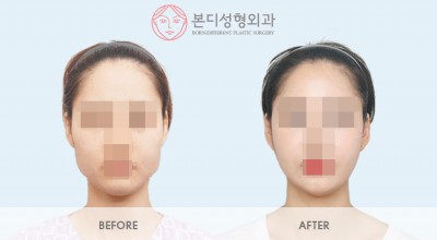 퀵광대, 수면돌려깎기, 근육절제술