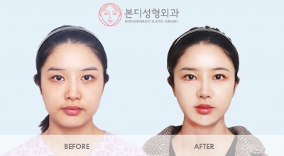 매몰+앞트임, 콧대+코끝, 메부리코, 이중턱지방흡입, 얼굴지방이식