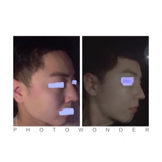 3D광대수술 한달차 입니다 큰붓기는 모두 빠진상태고  볼뭉침정도 약간 남아있는상태에요 한달정도되니 주변에서 못알아보는거같아요 !